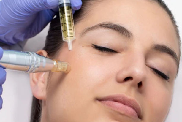 Skin Needling